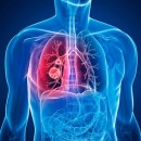 O que é Tuberculose, sintomas, tratamento e tipos